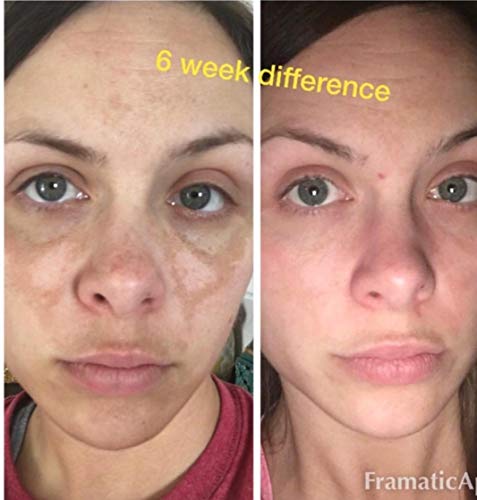 Dark Spot Corrector Remover for Face Melasma Treatment Fade Cream with Kojic Acid Vitamin C, Salicylic Acid, Azelaic Acid, Lactic Acid Peel (1oz)