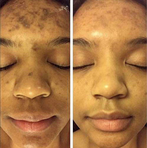 Dark Spot Corrector Remover for Face Melasma Treatment Fade Cream with Kojic Acid Vitamin C, Salicylic Acid, Azelaic Acid, Lactic Acid Peel (1oz)