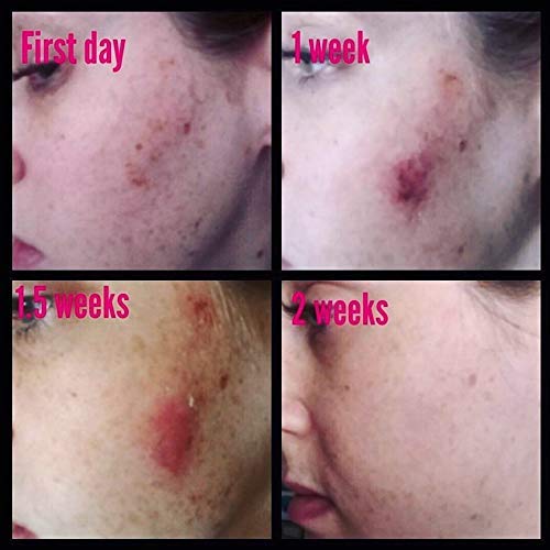Dark Spot Corrector Remover for Face Melasma Treatment Fade Cream with Kojic Acid Vitamin C, Salicylic Acid, Azelaic Acid, Lactic Acid Peel (1oz)