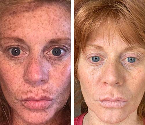 Dark Spot Corrector Remover for Face Melasma Treatment Fade Cream with Kojic Acid Vitamin C, Salicylic Acid, Azelaic Acid, Lactic Acid Peel (1oz)
